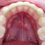 Bonded-retainers-lower-teeth
