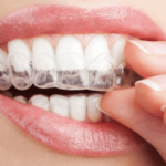 clear-invisible-retainer