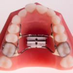 palatal-expander-300x184