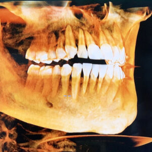 3D dental X-ray image displaying advanced technology used to create personalized orthodontic treatment plans tailored to each patient’s unique needs.