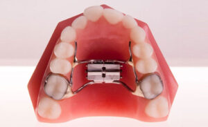 Orthodontic model displaying a palatal expander, illustrating how maxillary expansion can create space, improve alignment, and support healthy jaw development.