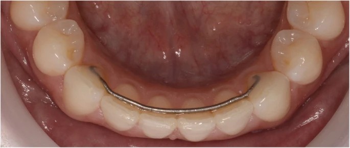 Lower bonded retainer to maintain excellent orthodontic results.
